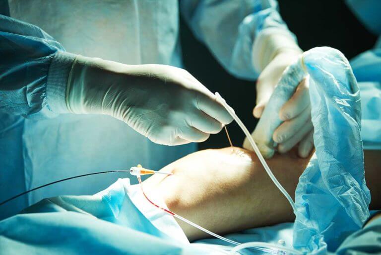 varicose-vein-surgeon-procedure-mackay-768x513