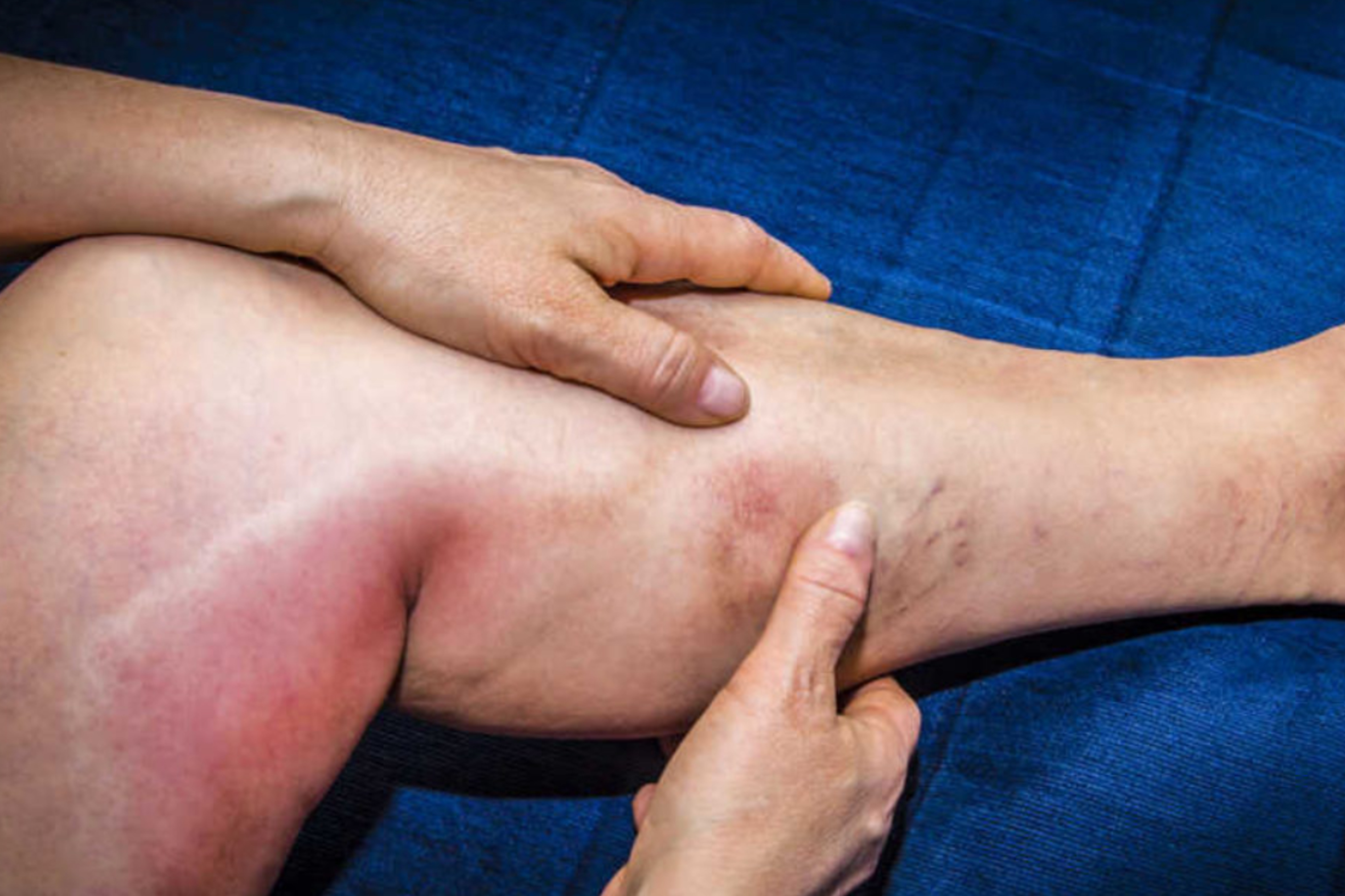 Deep Vein Thrombosis