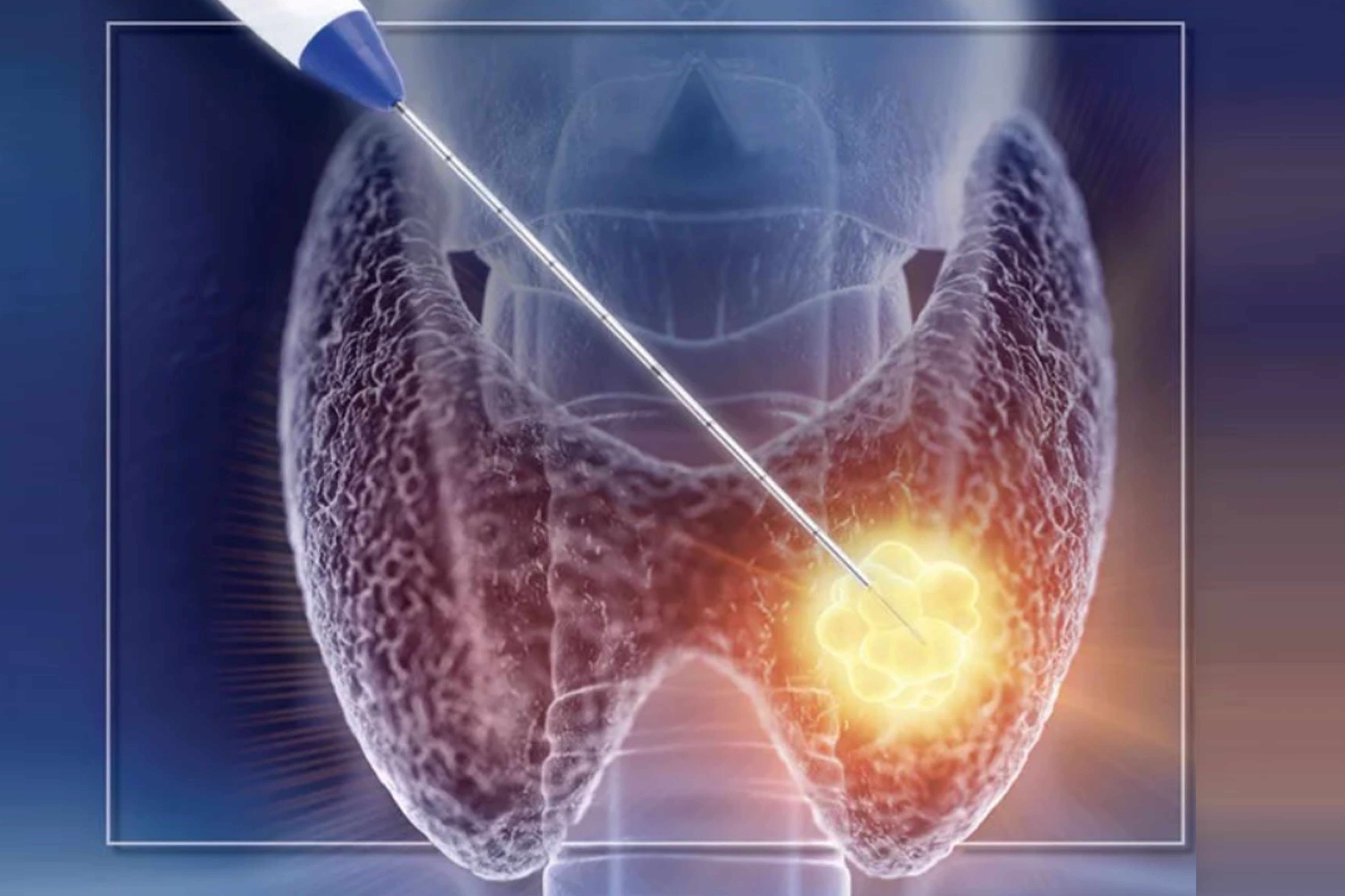 Thyroid Ablation